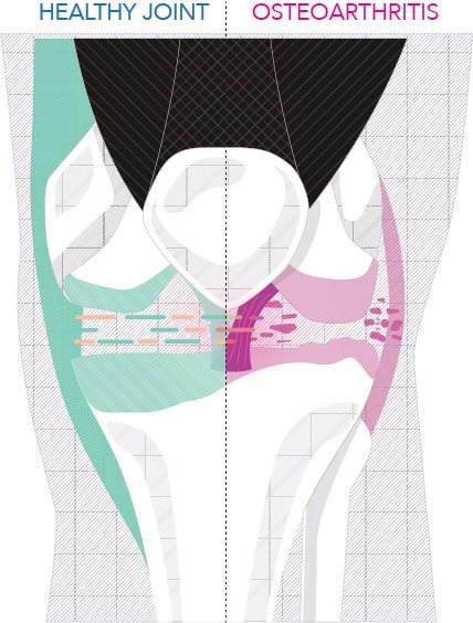 knee OA_1
